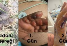 65 Yaş Yılan Isırma Olgusu