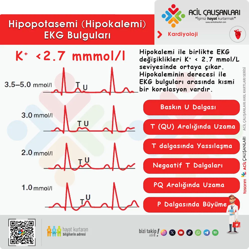 Hipopotasemi ve Hipokalemi EKG Bulguları