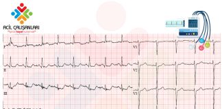 Lateral Duvar Miyokard Enfarktüsü