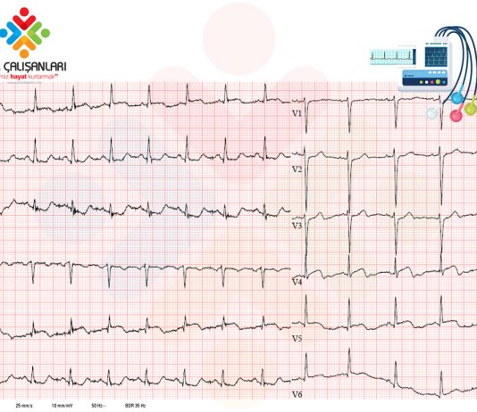 Lateral Duvar Miyokard Enfarktüsü