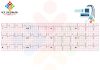 Yüksek Lateral STEMİ