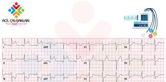 Yüksek Lateral STEMİ
