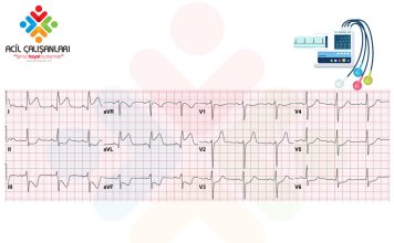 Yüksek Lateral STEMİ