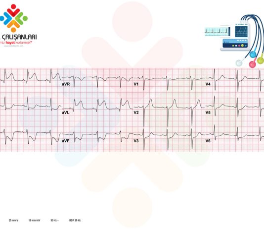 Yüksek Lateral STEMİ