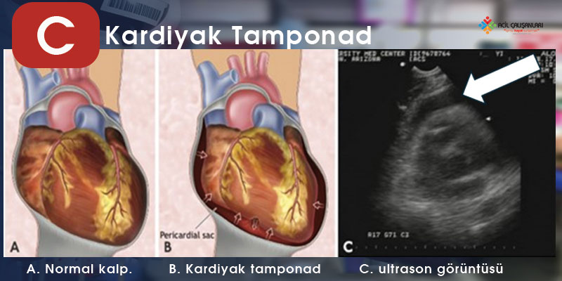 Kardiyak Tamponad Banner