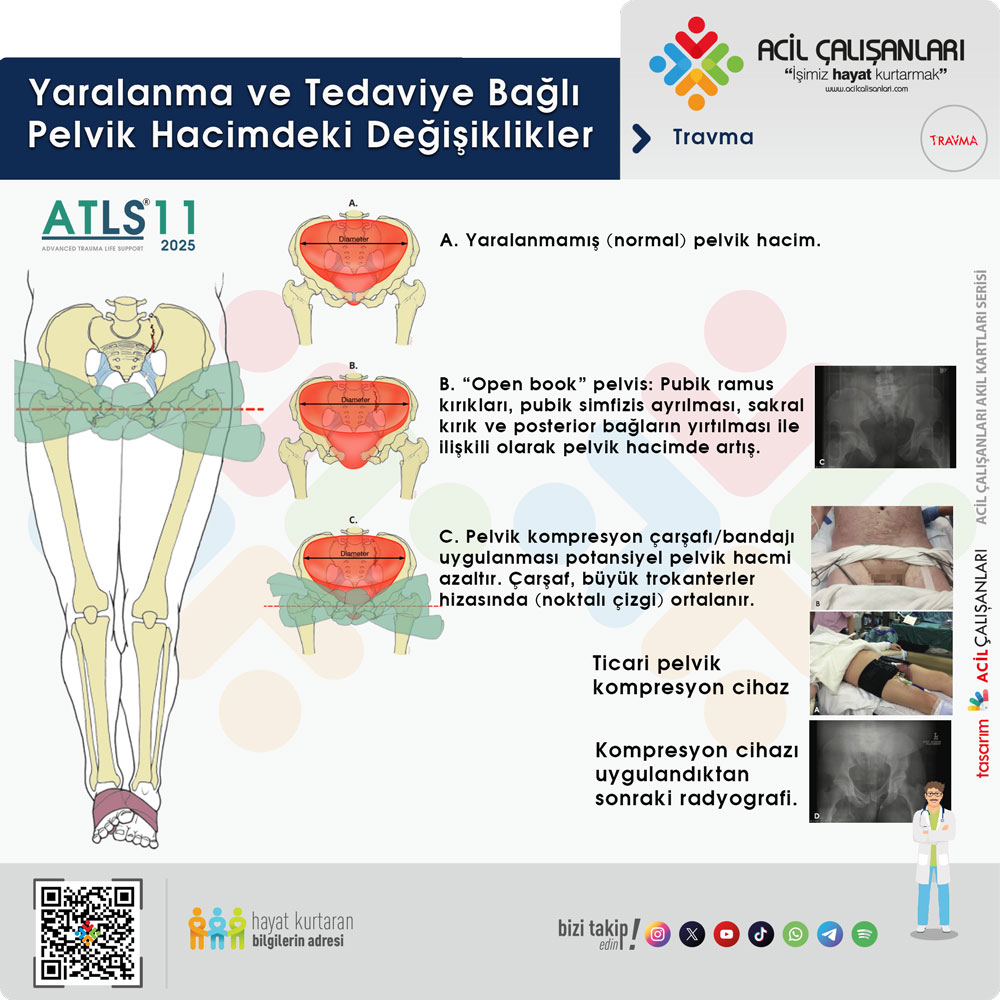 Pelvis Yaralanması Hacim