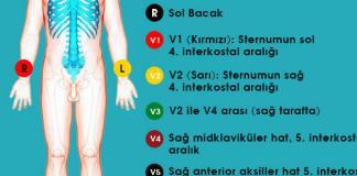 EKG’de Artefaktlar ve Yanlış Yerleştirme