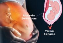 Ablasyo Plasenta (Plasenta Dekolmanı) Acil Yaklaşım
