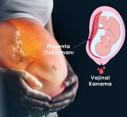 Ablasyo Plasenta (Plasenta Dekolmanı) Acil Yaklaşım