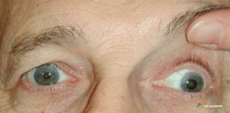 Okülomotor (3.) Sinir Felci