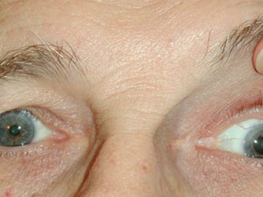 Okülomotor (3.) Sinir Felci