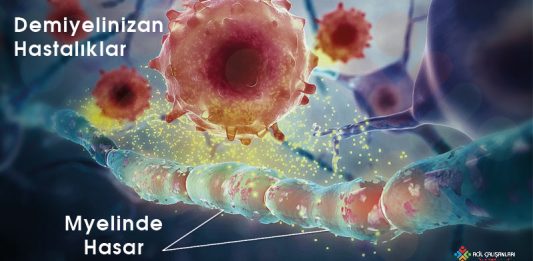 Multiple Skleroz (MS)