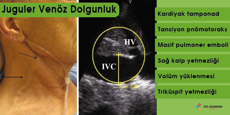 Juguler Venöz Dolgunluk