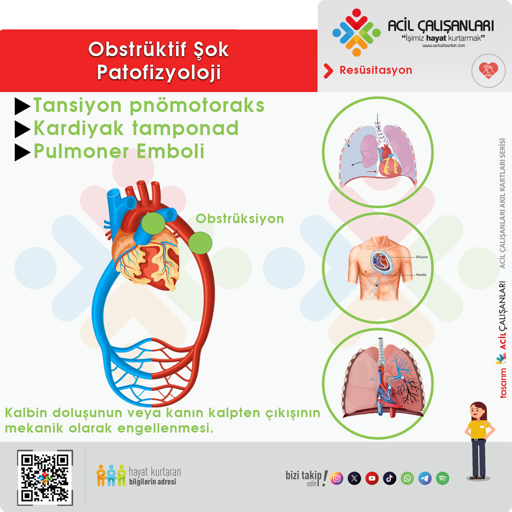Obstrüktif Şok Patofizyolojisi
