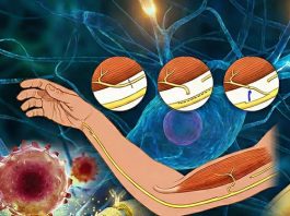 Periferik Sinir Yaralanmaları