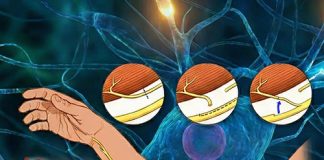 Periferik Sinir Yaralanmaları