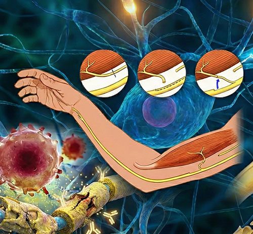 Periferik Sinir Yaralanmaları