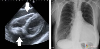 Perikardiyal Effüzyon