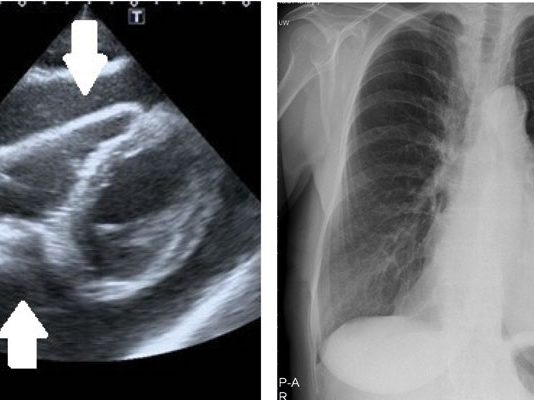 Perikardiyal Effüzyon