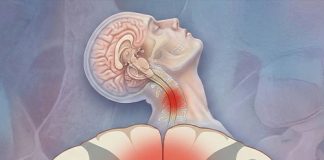 Santral Kord Sendromu