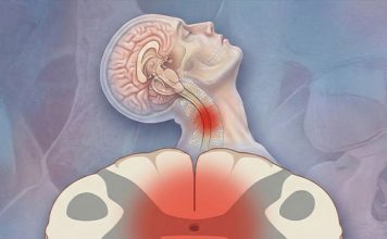 Santral Kord Sendromu