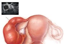 Tuboovarian Abse (TOA)