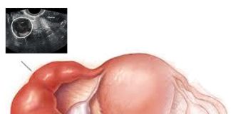 Tuboovarian Abse (TOA)