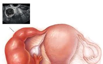 Tuboovarian Abse (TOA)