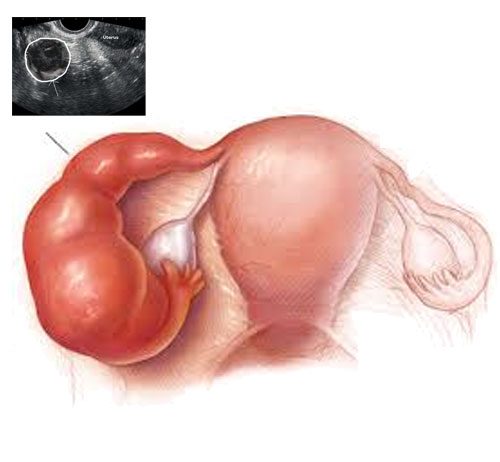 Tuboovarian Abse (TOA)