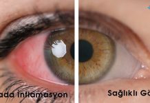 Üveit Acil Yaklaşım