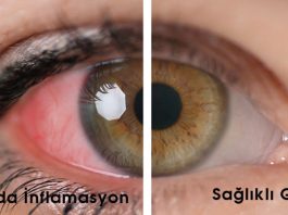 Üveit Acil Yaklaşım