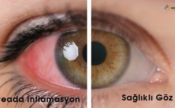 Üveit Acil Yaklaşım