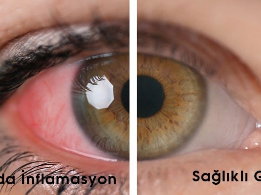 Üveit Acil Yaklaşım