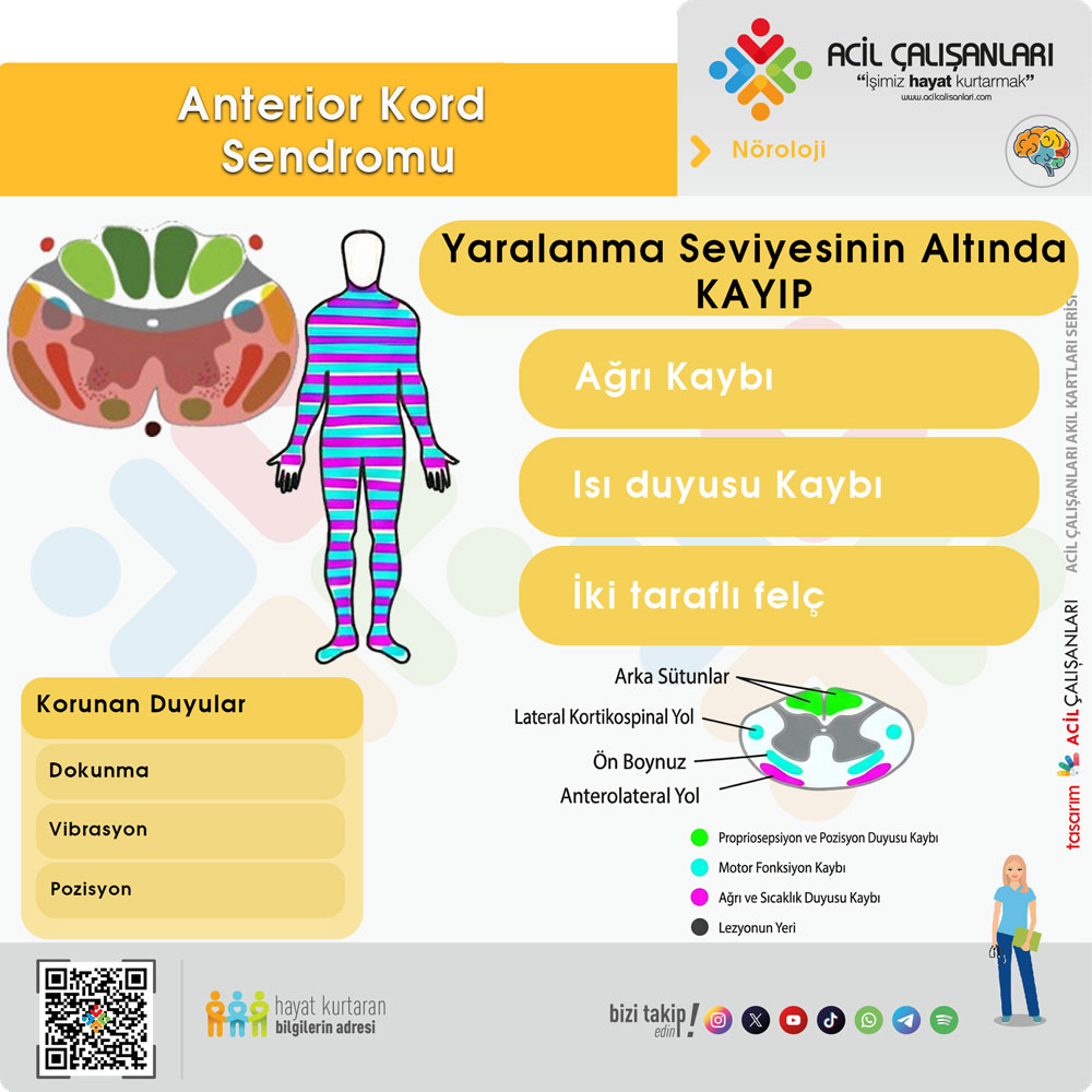 Anterior Kord Sendromu