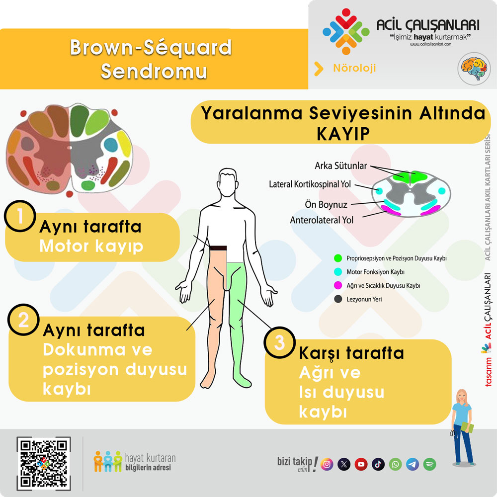 Brown-Sequard Sendromu