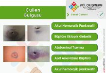 Cullen (Sign) Bulgusu