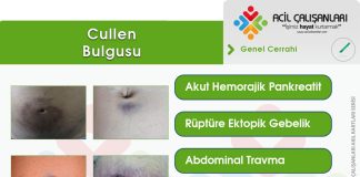 Cullen (Sign) Bulgusu