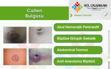 Cullen (Sign) Bulgusu