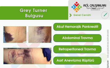 Grey Turner (Sign) Bulgusu