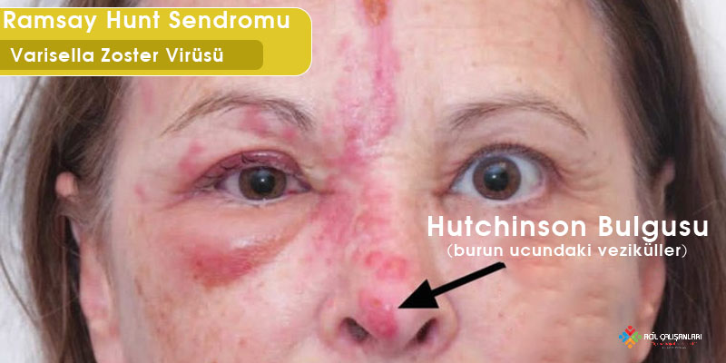 Ramsay Hunt Sendromu