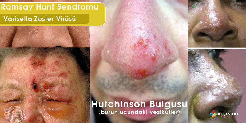 Hutchinson Bulgusu