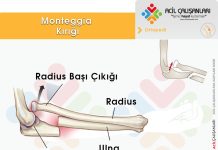 Monteggia Kırığı