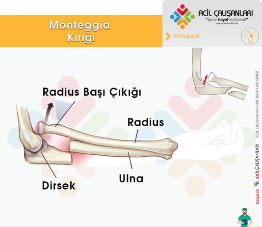 Monteggia Kırığı
