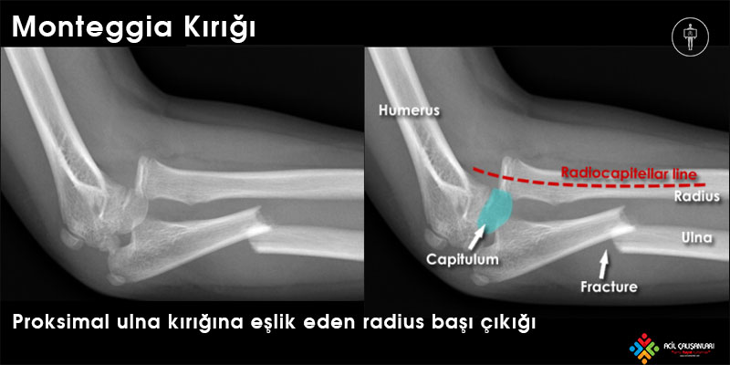 Monteggia Kırığı Radyografi