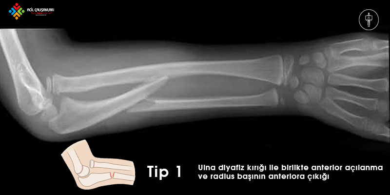 Monteggia Kırığı Tip 1