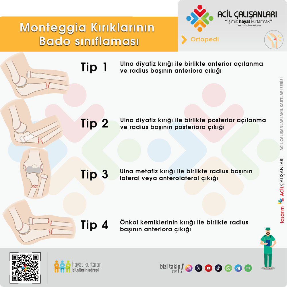 Monteggia Kırığı Sınıflaması