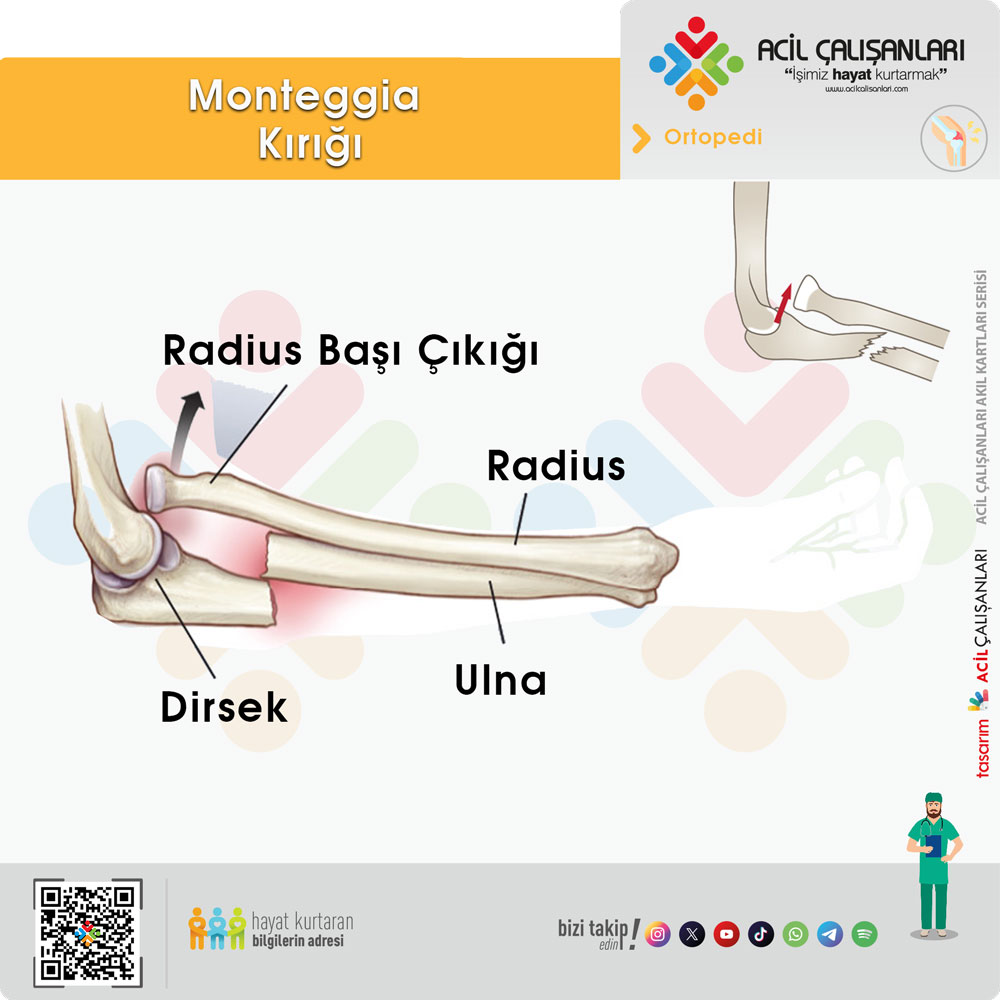 Monteggia Kırığı