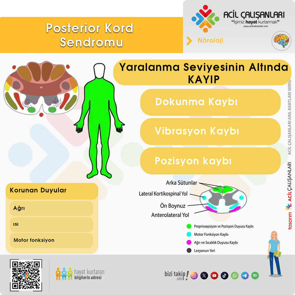 Posterior Kord Sendromu