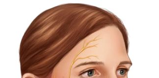 Ramsay Hunt Sendromu