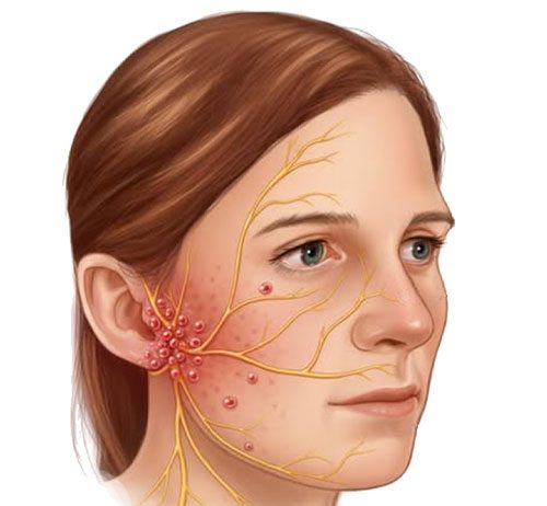 Ramsay Hunt Sendromu